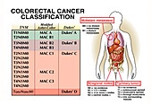 Colorectal cancer classification, illustration