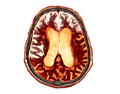 Frontotemporal dementia, MRI and CT scans