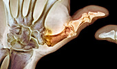 Osteoarthritis of the thumb, X-ray