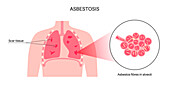 Asbestosis lung disease, illustration