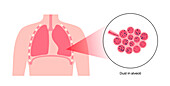 Pneumoconiosis lung disease, illustration