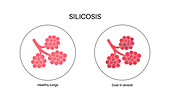 Silicosis dust in lung, illustration