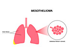 Mesothelioma cancer disease, illustration