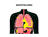 Mesothelioma cancer disease, illustration