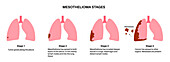 Mesothelioma cancer stages, illustration