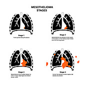 Mesothelioma cancer stages, illustration