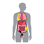 Mesothelioma tumour types, illustration