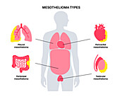 Mesothelioma tumour types, illustration