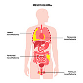 Mesothelioma tumour types, illustration
