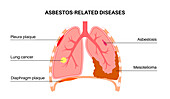 Asbestos related diseases, illustration