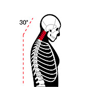 Neck vertebrae deformity, illustration