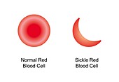 Normal and sickle red blood cells, illustration