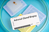Adrenal gland biopsy