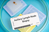Axillary lymph node biopsy