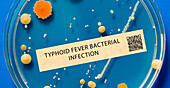 Typhoid fever bacterial infection