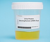 Urine protein electrophoresis test