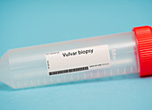 Vulvar biopsy