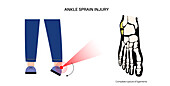 Ankle sprain injury, illustration