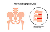 Ankylosing spondylitis, illustration