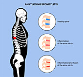 Ankylosing spondylitis, illustration