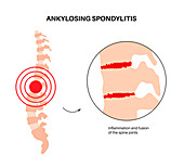 Ankylosing spondylitis, illustration