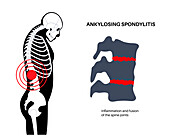 Ankylosing spondylitis, illustration
