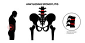 Ankylosing spondylitis, illustration