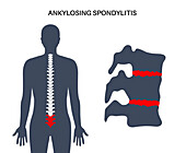 Ankylosing spondylitis, illustration