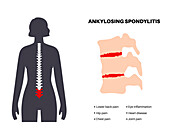 Ankylosing spondylitis, illustration