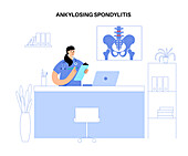 Ankylosing spondylitis, illustration