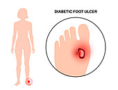 Diabetic foot syndrome, illustration
