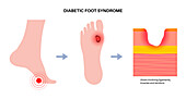 Diabetic foot ulcers, illustration