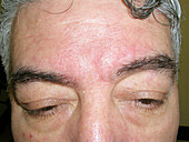 Seborrheic dermatitis