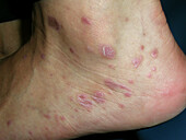 Lichen planus