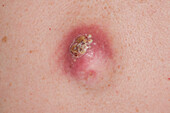 Infected sebaceous cyst on a woman's back