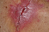 Infected wound following surgery on a woman's shoulder