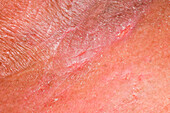 Atopic eczema on a woman's neck