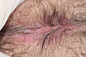 Perianal dermatitis in a male patient