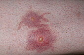 Reaction to mosquito bites on a woman's leg
