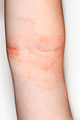 Eczema on a girl's inner elbow