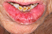 Lip ulceration in a female patient