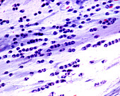 Sputum smear in acute bronchitis, light micrograph
