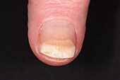 Dystrophic nails in female patient