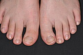 Big toe curved inwards in a male patient