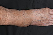Erosive arthritis on a woman's ankle