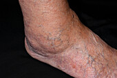 Erosive arthritis on a woman's ankle