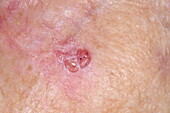 Basal cell carcinoma on a woman's cheek