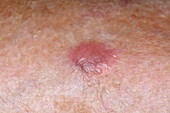 Amelanotic melanoma on a woman's shin