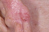 Basal cell carcinoma of pinna in a male patient
