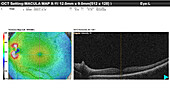 Healthy eye, OCT scan